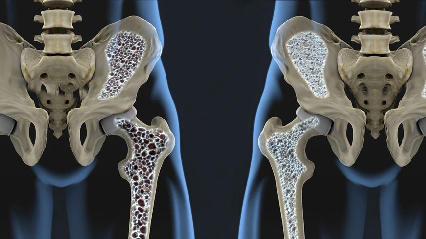 Can Total Knee Replacement affect diabetes