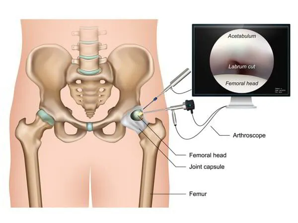 Hip Arthroscopy Dr. Pradyumna