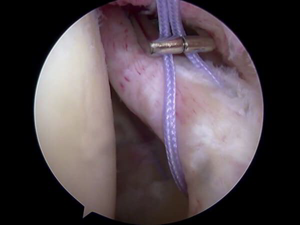 SLAP Repair Surgeon Dr. Pradyumna