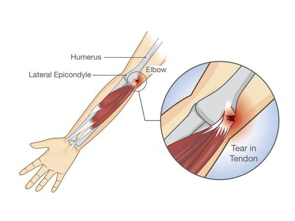 Elbow Tendon Surgeon Dr. Pradyumna
