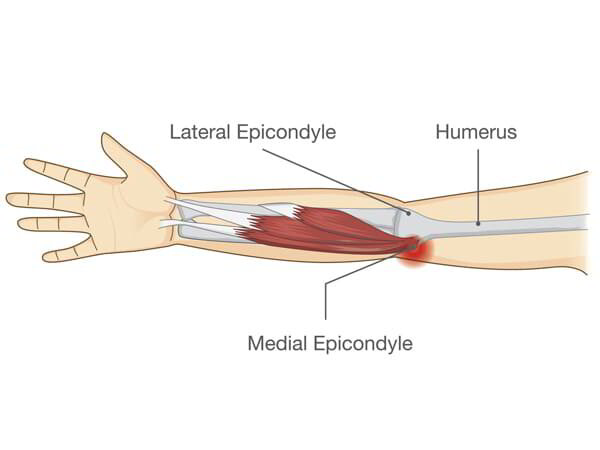 Golfer Elbow Surgeon Dr. Pradyumna