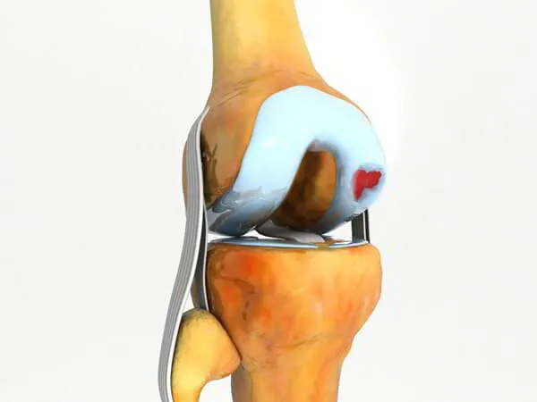 Cartilage Transplant Dr. Pradyumna