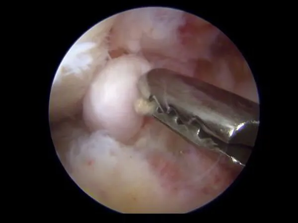 Removal of Loose Bodies Dr. Pradyumna