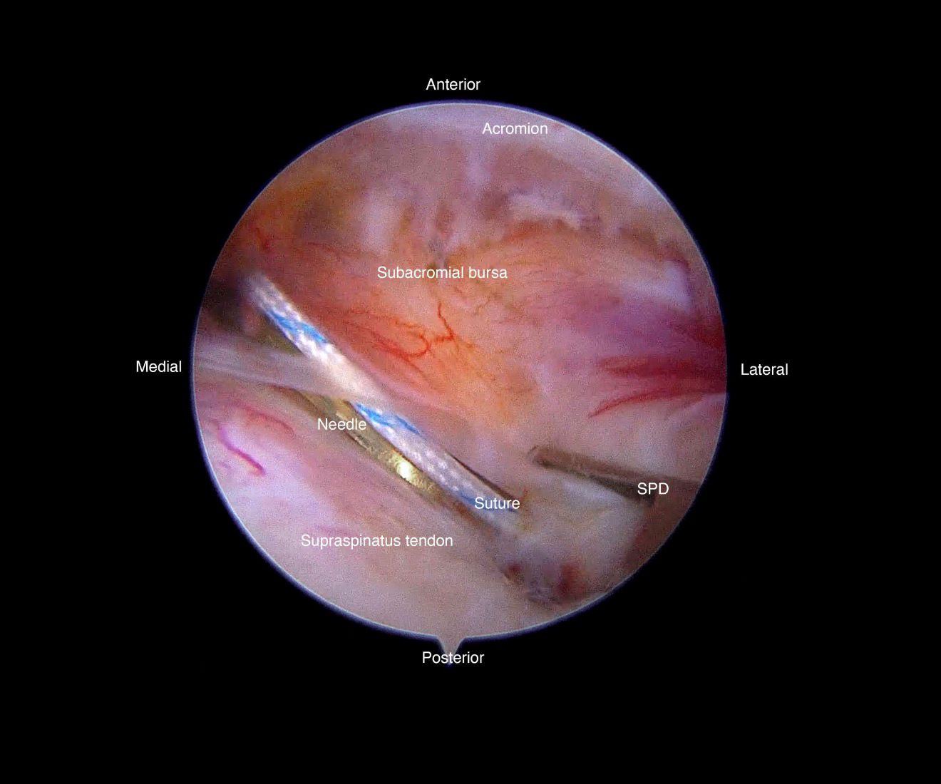 Shoulder arthroscopy safety and recovery
