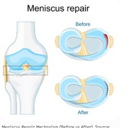 Meniscus Repair Mechanism (Before vs After)