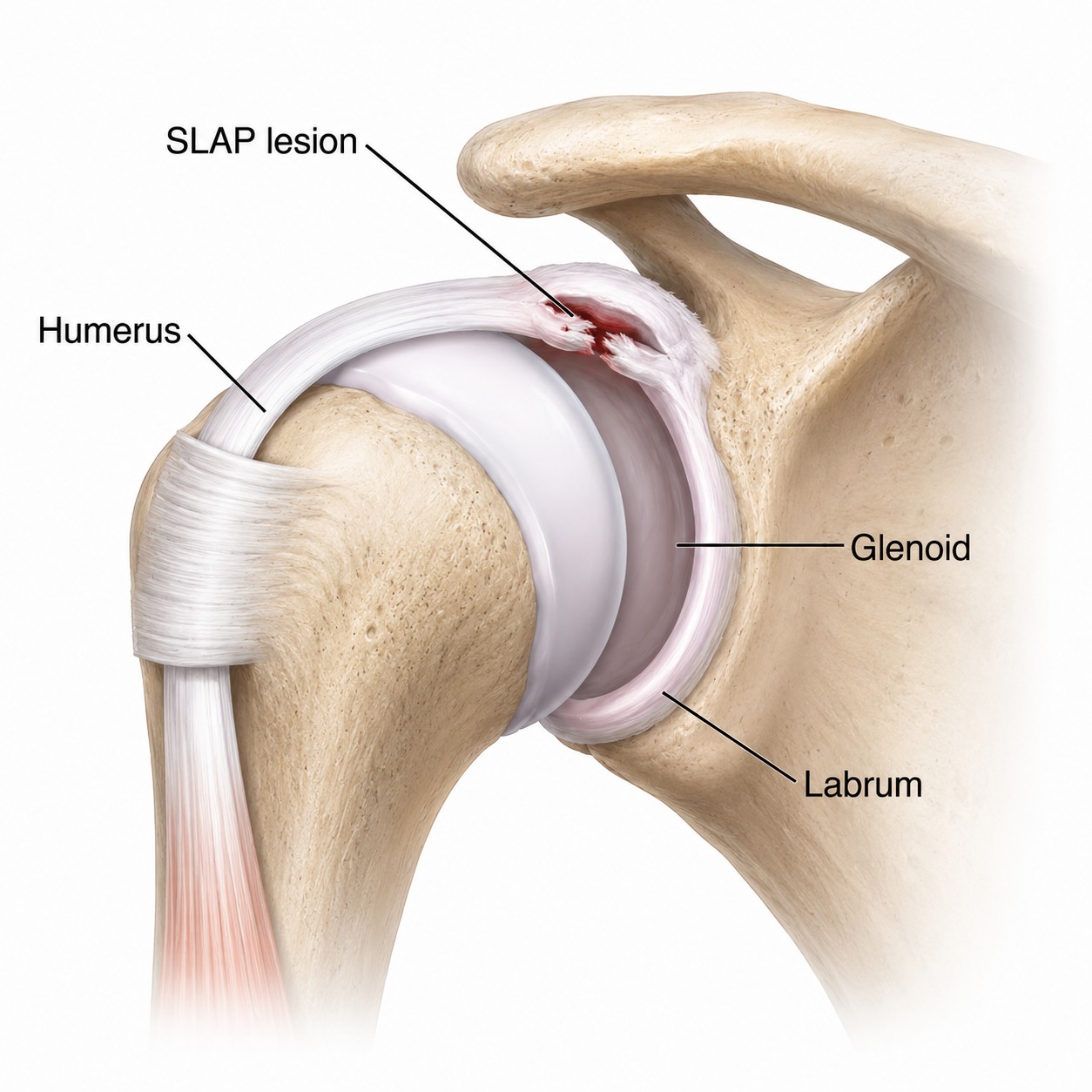 SLAP tear shoulder labrum tear treatment
